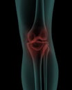 Front x-ray view of human painful knee