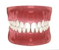 Frontal crown lengthening, Esthetic surgery. Medically accurate dental 3D illustration