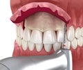 Frontal crown lengthening, Esthetic surgery. Medically accurate dental 3D illustration