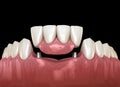 Frontal teeth bridge supported by implants. Medically accurate 3D animation of dental concept