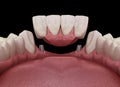 Frontal teeth bridge supported by implants. Medically accurate 3D animation of dental concept