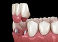 Frontal teeth bridge supported by implants. Medically accurate 3D animation of dental concept