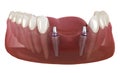 Frontal teeth bridge supported by implants. Medically accurate 3D animation of dental concept