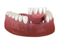 Frontal teeth bridge supported by implants. Medically accurate 3D animation of dental concept