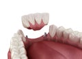 Frontal teeth bridge supported by implants. Medically accurate 3D animation of dental concept