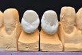 Frontal teeth implant
