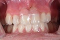 Removable partial prosthetic central incisor crowns.