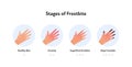 Frostbite anatomical infographic poster. Vector flat medical illustration. Stages of hypotermia. Hand with finger stage of healthy