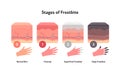 Frostbite anatomical infographic. Vector flat healthcare illustration. Stages of hypothermia and windburn. Skin layers and hand