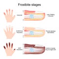 Frostbite stages of fingers