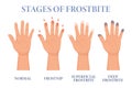 Frostbite stages. Frozen hands in different stages. Medical frostbite. Skin burn symptom. Health care medical concept.