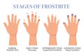 Frostbite stages. Frozen hands in different stages. Medical frostbite. Health care medical concept. Vector