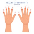 Frozen hands in different stages. Medical frostbite. Stages of frostbite of fingers. Medical healthcare concept. Vector