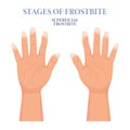 Frozen hands in different stages. Medical frostbite. Stages of frostbite of fingers. Medical healthcare concept. Vector