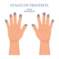 Frozen hands in different stages. Medical frostbite. Stages of frostbite of fingers. Medical healthcare concept. Vector