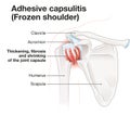 Frozen shoulder. Adhesive capsulitis. Illustration_5 Royalty Free Stock Photo