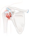 Frozen shoulder. Adhesive capsulitis. Labeled Illustration Royalty Free Stock Photo