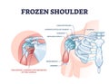 Frozen shoulder condition or adhesive capsulitis syndrome outline diagram