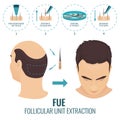 FUE hair loss treatment Royalty Free Stock Photo