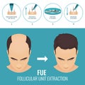 FUE hair loss treatment Royalty Free Stock Photo