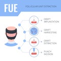 FUE hair transplantation medical infographics for men