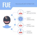 FUE hair transplantation medical infographics for women Royalty Free Stock Photo