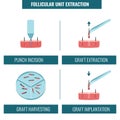 FUE hair transplantation procedure stages medical infographics