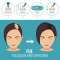 FUE treatment for women