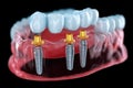 Full Arch Restoration with Dental Implants Prosthesis Royalty Free Stock Photo