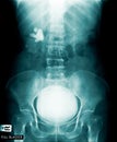 Full bladder x-ray image