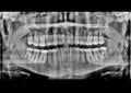 Full mouth dental x-ray picture