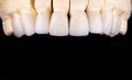 Full mouth teeth made of zircon arch ceramic crowns human teeth of upper veneers of teeth prothesis. Dental restoration treatment Royalty Free Stock Photo
