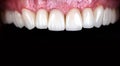 Full mouth teeth made of zircon arch ceramic crowns human teeth of upper veneers of teeth prothesis. Dental restoration treatment