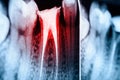Full Obturation of Root Canal Systems On Teeth