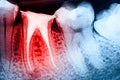 Full Obturation of Root Canal Systems On Teeth Royalty Free Stock Photo