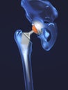 Function of a hip joint implant or hip prosthesis in frontal view