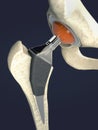 Function of a hip joint implant or hip prosthesis in frontal view