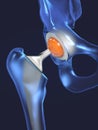 Function of a hip joint implant or hip prosthesis in frontal view