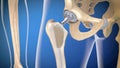 Function of a hip joint implant or hip prosthesis in frontal view