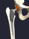 Function of a hip joint implant or hip prosthesis in frontal view