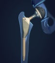 Function of a hip joint implant or hip prosthesis in frontal view