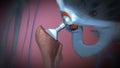 Function of a hip joint implant or hip prosthesis in frontal view