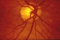 Fundus photography - Normal human retina