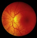 Fundus photography - Retina