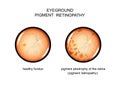 Fundus. pigment retinopathy Royalty Free Stock Photo