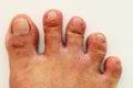 Fungal infection of the area between the toes Royalty Free Stock Photo