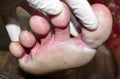 Fungal infection called tinea pedis at foot of Asian woman