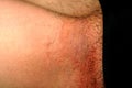 Fungal infection in the groin, Psoriasis, dermatitis, eczema.