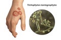 Hand fungal infection, tinea manuum, 3D illustration