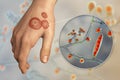 Hand fungal infection, tinea manuum, 3D illustration